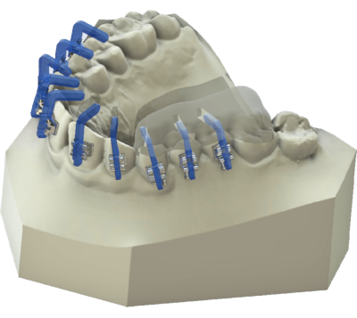 maestro3d | Dental Studio | Ortho Studio | Clear Aligner | Brackets JIG Tray