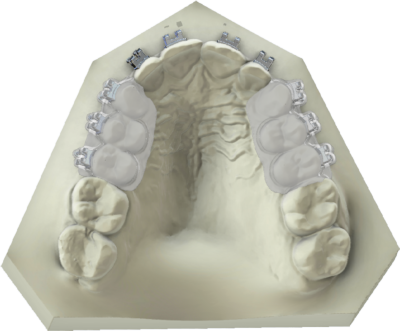 maestro3d | Dental Studio | Ortho Studio | Clear Aligner | Brackets Tray