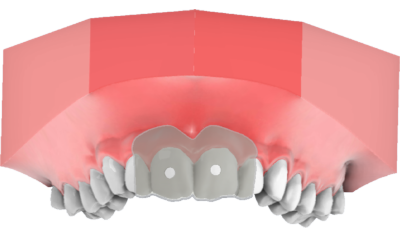 maestro3d | Dental Studio | Ortho Studio | Clear Aligner | Etching guide for attachment placement