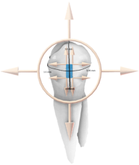 Maestro 3D | Dental Studio | Ortho Studio | Attachments