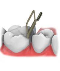 Maestro 3D | Dental Studio | Ortho Studio | IPR | Interproximal Reduction